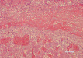 Fig. 2. Serofibrinous perihepatitis consequent to E. coli septicaemia in a broiler chicken. Huge fibrinous pseudomembrane (f), coating the liver surface. H/E, Bar = 50 µm