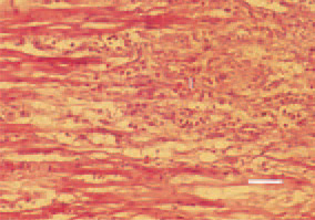 Fig. 3. Myocardial infarction (I) as a
result of thromboemboly. Focal degenerative
necrobiotic lesions and
beginning of organization, appearance
of macrophages. H/E, Bar = 25
µm.