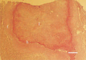 Fig. 4. Widespread anaemic infarct
(I) in the spleen of a duck. A peripherally
reactive marginal zone of
hyperaemia (h), necrotic heterophils
and early fibroblastosis (f). The lesion
is clearly delineated by the adjacent
healthy parenchyma and is generally
resulting from a portal venous thrombosis.
H/E, Bar = 100 µm.