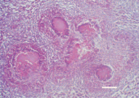 Fig. 5. Tubercle, liver, hen. A characteristic
finding in avian tuberculosis
are conglomerate tubercles, formed
by several nodules having merged
into a common mass. H/E, Bar = 50
µm.