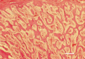 Fig. 3. Haemorrhages and inflammatory
necrotic lesions affecting the
pneumatized skull bones in a female
broiler breeder, 33 weeks of age,
H/E, Bar = 70 µm.