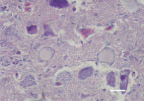 Fig 2. & Fig 3. A particularly valuable
finding is the central chromatolysis of
neurons in the segments of the lumbosacral
spinal cord enlargement,
and less frequently, chromatopyknosis.
H/E, Bar = 25 µm.