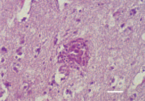 Fig. 1 & Fig. 2. Non-purulent encephalitis.
Perivascular microglial proliferation.
H/E, Bar = 30 µm.
