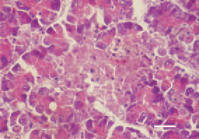 Fig. 4. Focal necrosis (N) in the pancreatic
parenchyma. H/E, Bar = 25
µm.