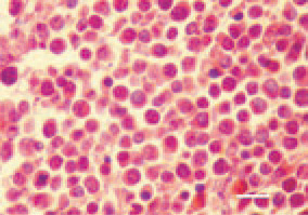Fig. 2. Acute (visceral) form, liver, hen.
Lymphomatous lesions, mainly consisting
of lymphoblasts, and small to
medium-sized lymphocytes. Among
the proliferate, single plasmatic and
reticular cells are outlined. H/E, Bar
= 10 µm.