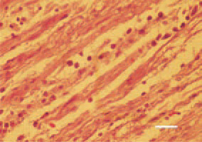 Fig. 10. Peripheral nerve, B-type lesion
(mostly inflammatory type).
Interneuritic inflammatory oedema
and slight to moderate proliferation
of lymphocytes and plasmatic cells,
rarely lymphoblasts. The mild version
of B-type lesions is called C-type. H/E,
Bar = 25 µm.