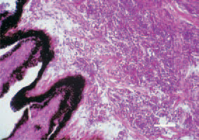 Fig. 12. Lymphoid cell proliferations
in the iris and ciliary muscles in the
ocular form of Marek’s disease. H/E,
Bar = 50 µm.