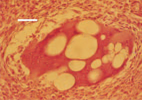 Fig. 11. Leiomyosarcoma, small intestine.
Extraordinary (“monstrous”)
multinuclear giant cell with intracytoplasmic
vacuoles. H/E, Bar = 25 µm.