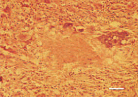 Fig. 12. Degenerative necrobiotic
process of a leiomyosarcoma metastasis
in the liver of a hen. H/E, Bar =
25 µm.