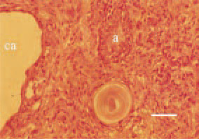 Fig. 16. Carcinosarcoma in the region
of the infraorbital sinus. Adeno- (a)
and cystadenocarcinomatous (ca)
structures among the sarcomatous
part of the parenchyma. H/E, Bar =
30 µm.