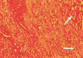 Fig. 17. Nephroblastoma. An area of
embryonal-like cells of mesenchymal
and epithelial origin. Simultaneous
presence of tubules (arrow) at a different
stage of development. Young
nondifferentiated tubules are not
clearly distinguished among the sarcomatous
structures. H/E, Bar = 30
µm.