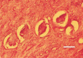 Fig.18. Nephroblastoma. A group
of poorly differentiated glomerular
structures among the neoplastic tissue
of a fibrous type. H/E, Bar = 50 µm.