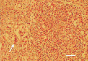 Fig. 22. Ovary, granulosa-theca cell
tumour. Tubulus-like formations (arrow)
of the tumour parenchyma.
H/E, Bar = 25 µm.