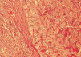 Fig. 24. Liver cell carcinoma. Growth
of rosette-like and tubulous structures
(a) surrounded by a dense fibrous
and well-vascularized capsule.
H/E, Bar = 50 µm.