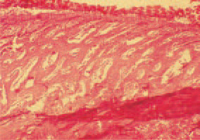Fig. 1. Osteopetrosis, tibiotarsal bone,
hen. Growth of the cancellous bone
from the endosteum to the periosteum.
Multiple large irregularly-shaped
lacunae. H/E, Bar = 35 What’s The
Worst That Could Happen µm.