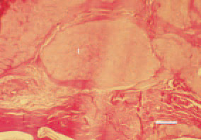 Fig. 2. Articular gout, transverse
cross-section, phalange, cock. Amorphous
masses (urates) in the periarticular
tissue, forming tophi (t), surrounded
by fibrous tissue. H/E, Bar
= 50 µm.
