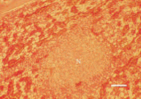 Fig. 1. A non-specific disease, more
exactly a lesion, associated to various
causes. In most cases, the condition is
accompanied with bacterial osteomyelitis.
The figure presents a necrotic
focus (N) among the bone marrow
of the femoral canal in a 40-day-old
broiler chicken with osteomyelitis.
H/E, Bar = 40 µm.