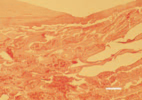 Fig. 2. The severe thinning of the cortex
in the femoral neck region consequently
to rickets, is among the
factors predisposing to femoral head
fractures and necroses. H/E, Bar = 50
µm.