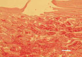 Fig. 3. Periosteal disruption and fracture
in the proximal femoral region
in a case of femoral head necrosis.
H/E, Bar = 50 µm.
