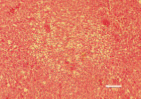 Fig. 1. Focal fatty degeneration, liver,
turkey. Cytoplasmic vacuoles correspond
to lipid droplets in hepatocytes,
extracted during the processing
of the histological cross-section.
Haemorrhages in the periphery. H/E,
Bar = 50 µm.