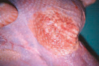 Cellulitis.
Affected areas are mostly in the region of the back and the thighs.