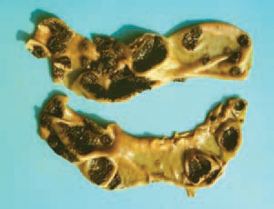 Coligranuloma (Hjarre's disease). It is characterized by multiple granulomas in the intestinal tract, the mesentery and the liver, but not in spleen. The lesions are similar to these observed in tuberculosis.