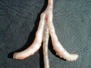 Diarrhoea, dehydration and pasted down appearance around the vent are observed. Pathoana-tomically, marked catarrhal haemorrhagic enteritis is observed. Often the caeca are filled with gelatinous, fibrinous, cheese-like exudate. This is a finding, characteristic for salmonellosis, but it is not specific for any of serotypes.