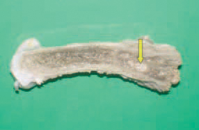 As a sequel to septicaemia, osteomyelitis could occur. The lesions are usually detected in the region of the proximal femur, where inflammatory necrotic foci in the bone marrow and partial or complete fracture of the femoral head are observed.