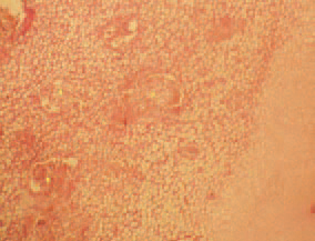 Histologically, staphylococcal lesions consist of necroses, bacterial colonization and heterophilic infiltration. The isolation and identification of Staphylococcus spp. confirms the diagnosis. From a differential diagnostical point of view, infections with E. coli, S. gallinarum, P. multocida, M. synoviae and reoviruses should be considered.