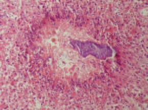 In many bile ducts, a biliary stasis is present and within some, among the stagnated secretion, a huge amount of microorganisms are detected. Pericanalicularly, coagulation necroses are frequently noticed. Among some of these foci, hyalinization of the necrotic masses and single microorganisms are present. Around the necroses, a belt of macrophages, lymphocytes and granulocytes is formed.