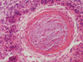 . Many Gram-positive bacteria are detected among granulomas, in bile ducts' lumen and into the gall bladder, often accompanied by inflammatory lesions. The mucosa of bile ducts and the gall bladder is frequently necrotized and the wall is thickened because of connective tissue growth. The diagnosis is based on the characteristic gross and microscopic lesions. The prevention is similar to that in NE.