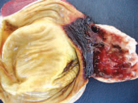 some cases, haemorrhages with various intensities are detected in the mucous coat of the gizzard. Prevention -separate housing of the different age groups of birds, avoiding the contact with other avian species. The pre-medication of forages with some antibiotics and their rotation would prevent the reproduction of CI. colinum. A good effect is achieved with oxytetra-cycline dihydrate (OTC 50% premix). UE could be effectively treated with doxycycline hydrochloride, amoxycillin etc.