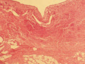 Microscopic lesions are characterized by oedema, emphysema, hyperaemia, haemorrhages and necroses in the subcutaneous tissues. GD could be effectively treated by tetracyclines: doxyxycline hydrochloride, erythromycin thiocyanate, chlortetracycline and copper sulfate in the water.