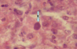 Microscopically, extensive dystrophic changes and necroses of liver parenchyma are detected. In the nuclei of hepatocytes, basophilic or eosinophilic inclusion bodies are detected. The basophilic inclusion bodies are usually dense and occupy the entire nuclear inner space (arrow b), whereas the eosinophilic ones are round or irregularly shaped and surrounded by a light halo (arrow e). The diagnosis is based upon the typical gross lesions and the history records.