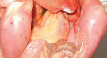Clinical signs could be observed only several hours prior to death occurrence. They consist in pale comb and wattles, depression and apathy. Sometimes, the skin is icteric. Often, ecchymoses and striated haemorrhages in skeletal muscles are observed.