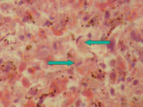 A characteristic diagnostic sign is the discovery of large acidophilic, rarely basophilic intra-nuclear inclusion bodies in the reticuloendothelial cells. The displaced and condensed nuclear chromatin pattern around the inclusion bodies often looks like a crescent.