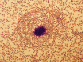The staining of peripheral blood smears reveals a picture, characte-ristic for septicaemia. The typical gross lesions and the history of the disease allow making a tentative diagnosis for HE. The histological detection of intranuclear inclusion bodies in the reticuloendothelial cells of the spleen or intestines confirms the diagnosis. For identification of the HEV, the agar gel precipitation method could be used. The viral antigen could be detected in fresh or frozen spleen tissue, diluted 1:1 with saline or in sera obtained from diseased turkeys. HE should be distinguished from other cases of severe enteritis in turkeys, acute E. coli septicaemia and some other septicaemic states (streptococcosis, fowl cholera etc.). Within weeks after the beginning of the disease, an appropriate antibiotic therapy should be initiated for prevention of secondary E. coli septicaemia. Practically, there is no effective therapy for HE in turkeys.