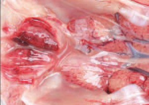 IBD lesions undergo various stages of serous haemorrhagic to severe haemorrhagic inflammation. The morbidity rate is very high and could reach 100%, whereas the mortality rate: 20 - 30%. The course of the disease is 5-7 days and the peak mortality occurs in the middle of this period.
