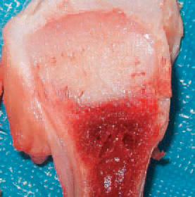 Dyschondroplasia is a defect of the growth plates in meat type poultry. It is characterized by abnormal cartilage masses under the growth plates of long bones. Most commonly, it is established in the proximal tibiotarsus and that is why it is called tibial dyschondroplasia. Dyschondroplasia could be also seen in the proximal and distal femur, the distal tibia and the proximal humerus. Clinically, affected chickens exhibit reluctance to move and lameness. Fractures could also be seen. The aetiology of dyschondroplasia is related to genetic factors, rapid growth in broilers, vitamin D metabolism, mycotoxins etc.